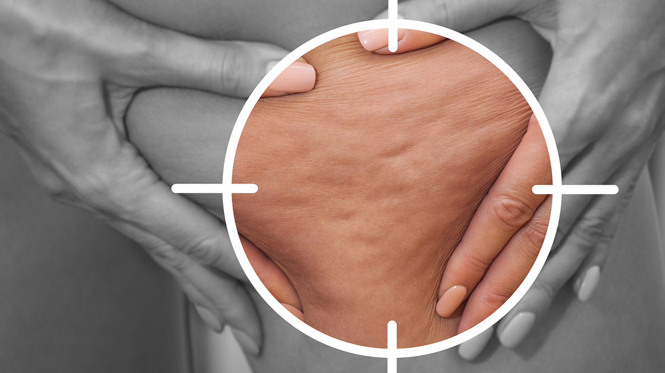 Breaking the silence on cellulite: A journey to self-acceptance